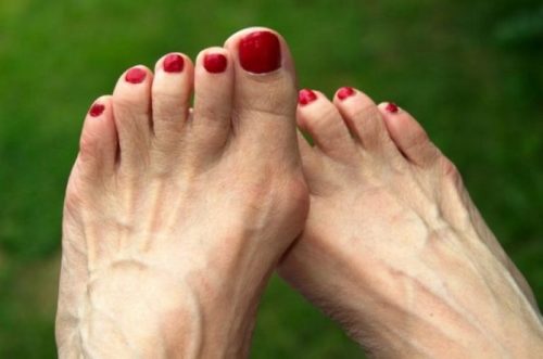 Причины и симптомы подагры на большом пальце ноги. Как лечить подагру на большом пальце ноги. Какое должно быть питание при подагре на большом пальце ноги