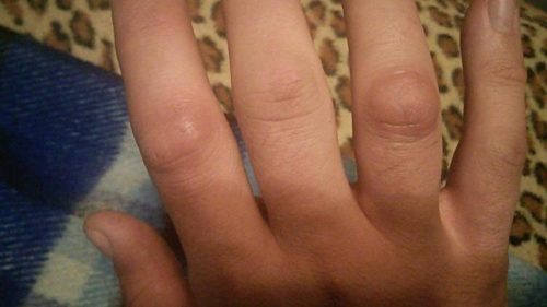 Выросла шишка на пальце руки под кожей