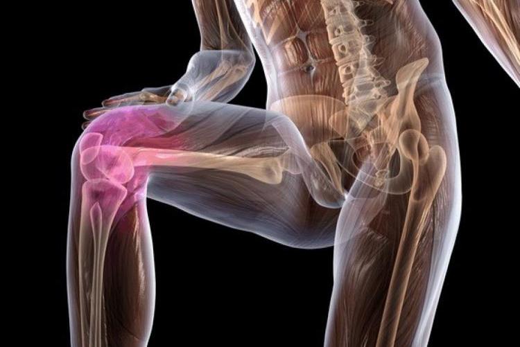Что такое деформирующий артроз коленного сустава: причины и симптомы. Степени деформирующего артроза коленного сустава. Лечение деформирующего артроза коленного сустава