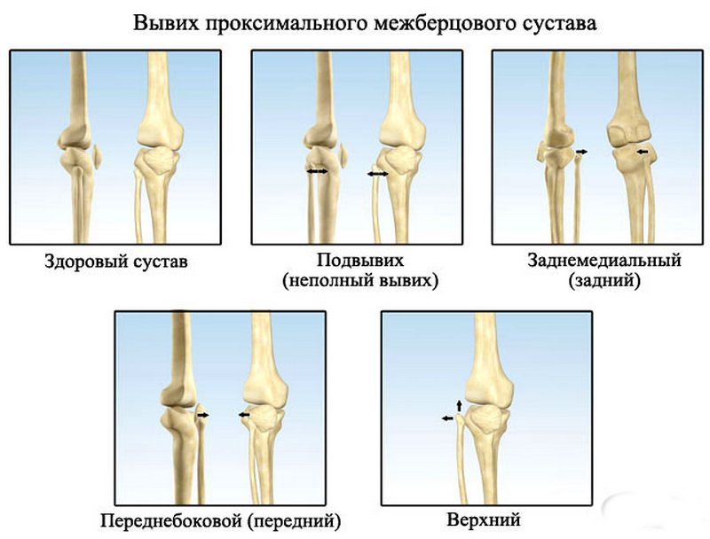 Смещение коленного сустава фото