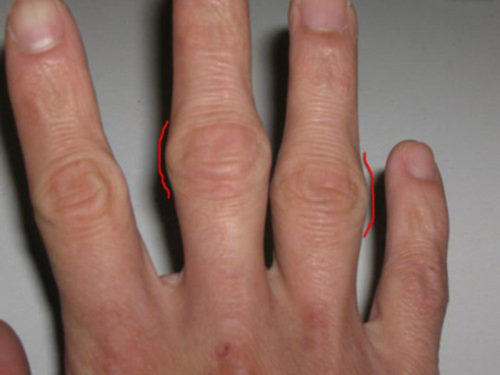 Шишка на среднем пальце руки под кожей