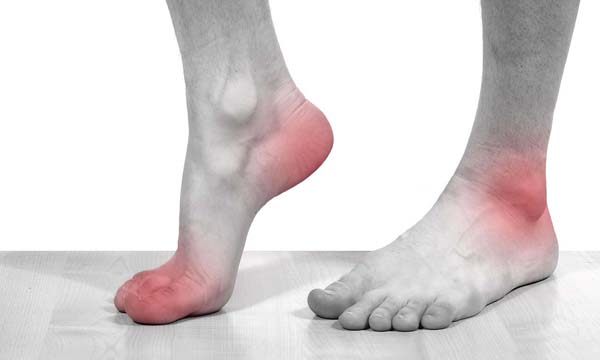 Причины и симптомы артрита суставов стопы. Лечение артрита суставов стопы