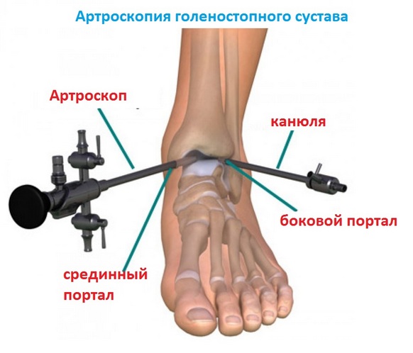 Артроз голеностопного сустава препараты. Артроскопический артродез. Артроскопия голеностопного сустава связки. Операция артродез голеностопного сустава. Артроцентез голеностопного сустава.