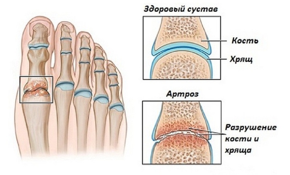 Остеоартроз что это такое как лечить. Артроз большого пальца стопы (i плюснефалангового сустава. Остеоартрит хряща 1 пальца стопы. Деформирующий артроз 1 плюснефалангового сустава стопы. Артрит и артроз большого пальца ноги.