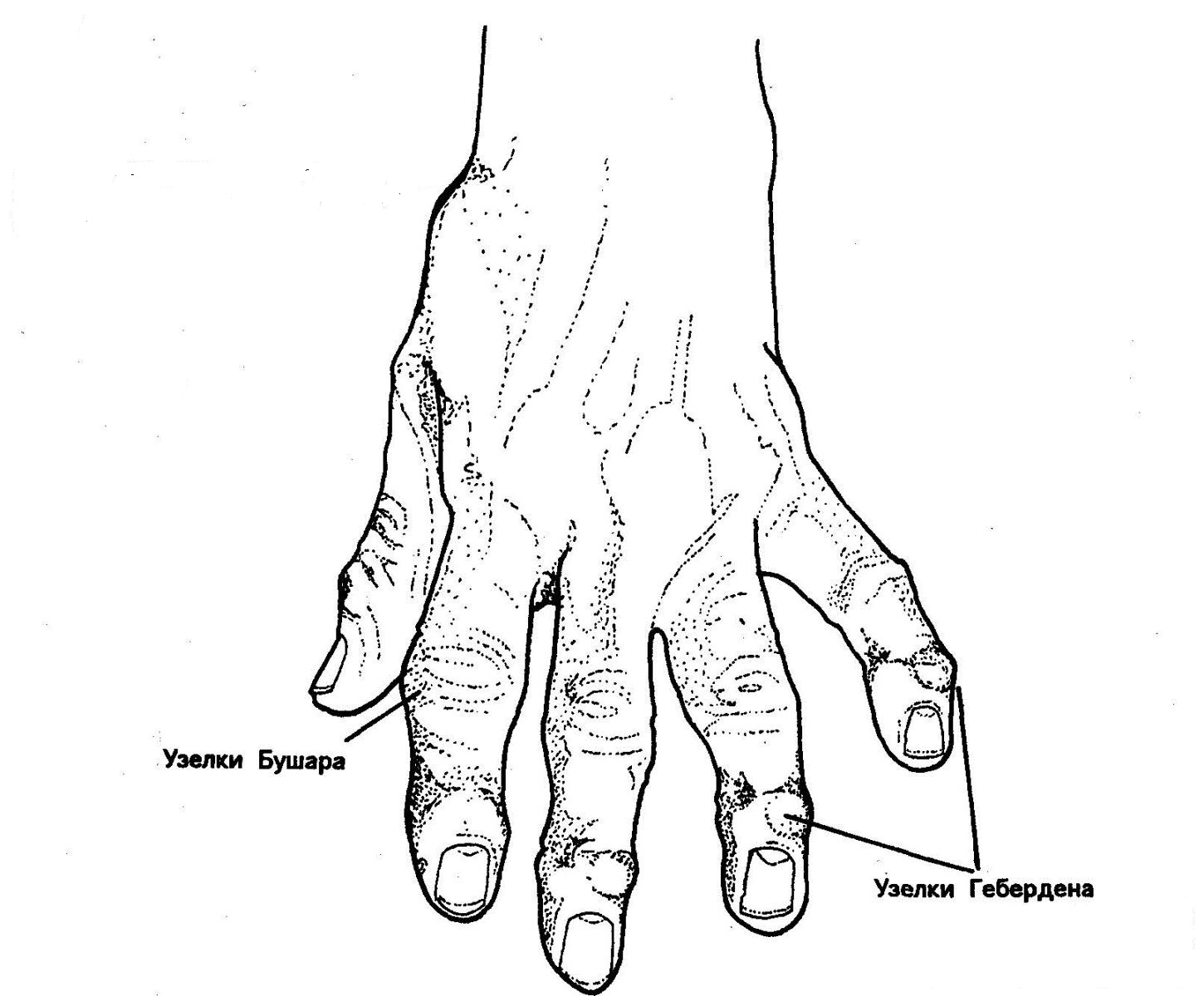 Узелки бушара лечение. Узелки Гебердена ревматоидный артрит. Узлы Гебердена и Бушара кисть. Узелки Гебердена и Бушара ревматоидный артрит. Межфаланговые суставы (узелки Гебердена, Бушара);.