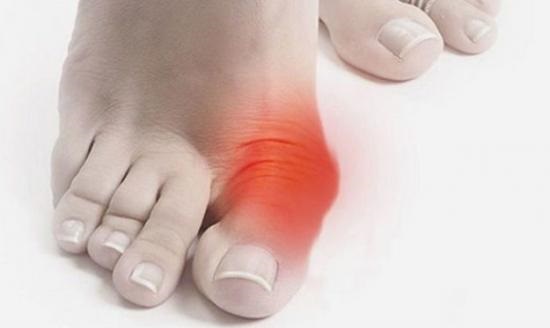 Причины боли в суставе большого пальца на ноге. Воспаление сустава большого пальца ноги. Лечение боли и воспаления сустава большого пальца ноги