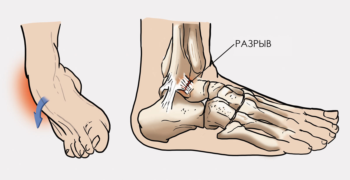 Рассмотрите изображение голеностопа человека как называют повреждение