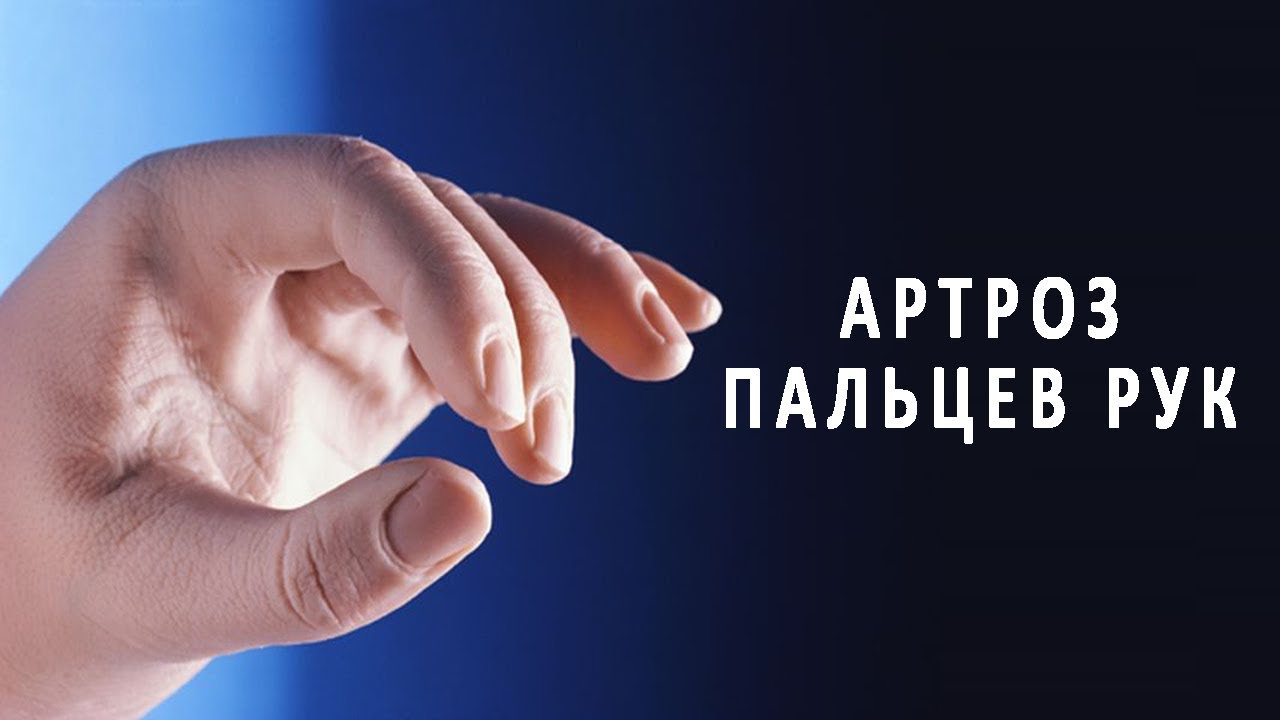 Причины и симптомы артроза пальцев рук. Лечение артроза пальцев рук: медикаментозные и народные средства. Упражнения и гимнастика при артрозе пальцев рук