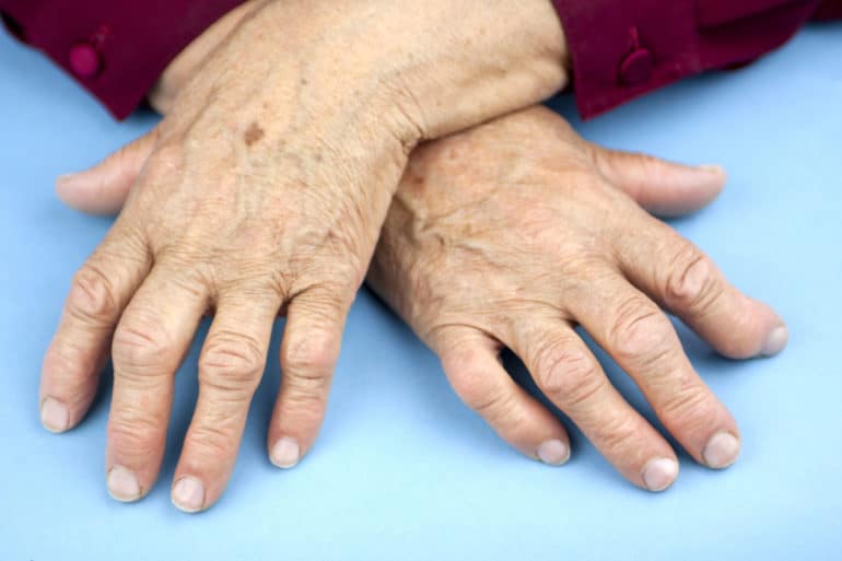 Причины и симптомы полиартрита пальцев рук. Как лечить полиартрит пальцев рук: медикаментозные и народные средства