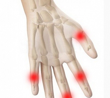 Симптомы и диагностика артроза кисти рук. Лечение артроза кисти рук: медикаментозные и народные средства. Гимнастика при артрозе кисти руки