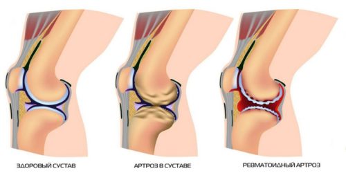 Какой укол делают в коленный сустав при артрозе thumbnail