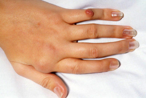 Болит сустав большого пальца на руке лечение народными средствами отзывы thumbnail