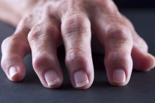 Болит сустав большого пальца на руке лечение народными средствами отзывы