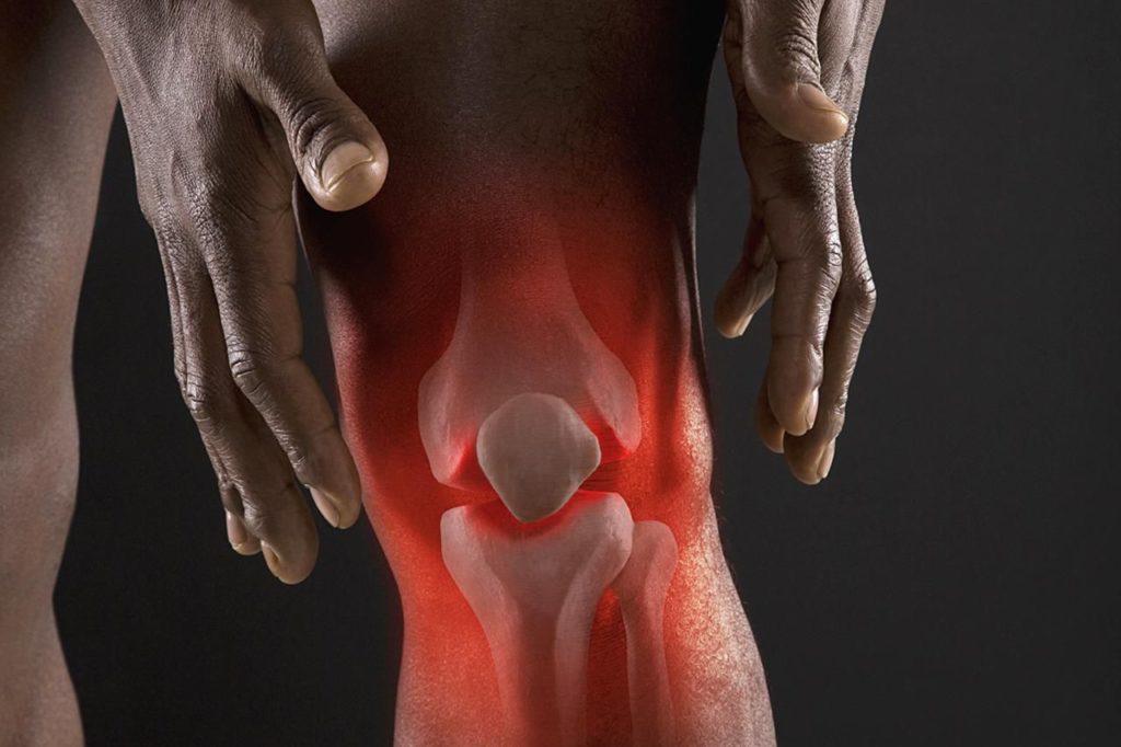 Признаки и симптомы кисты коленного сустава. Лечение кисты коленного сустава: медикаментозные и народные средства. Удаление кисты коленного сустава: показания к операции, как проводится