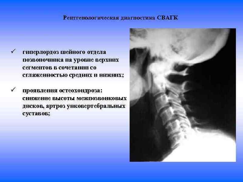 Унковертебральный артроз шейного отдела с5 с6