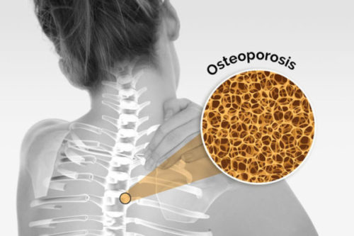 Упражнения для грудного отдела позвоночника при остеопорозе