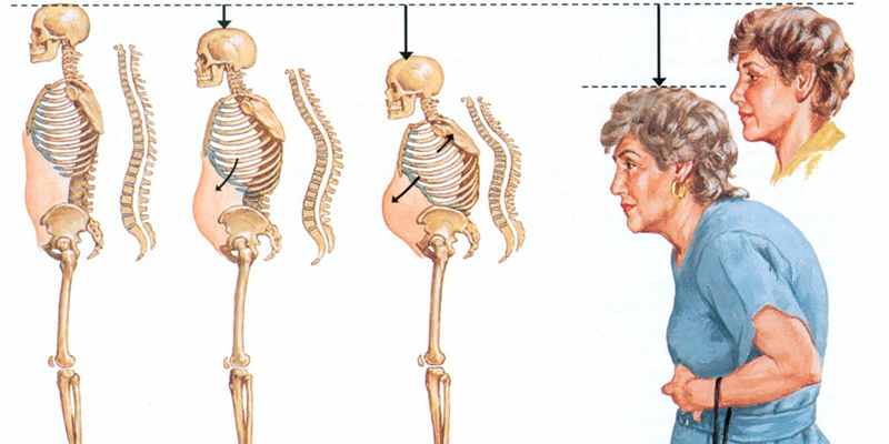 Упражнения для грудного отдела позвоночника при остеопорозе