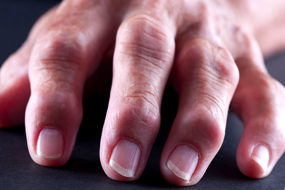 Причины, признаки и симптомы артроза пальцев, фото. Лечение артроза пальцев рук и ног. Гимнастика и упражнения при артрозе пальцев рук
