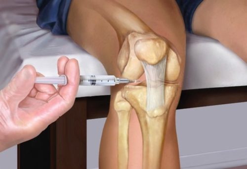Артроз коленного сустава лечение дипроспаном
